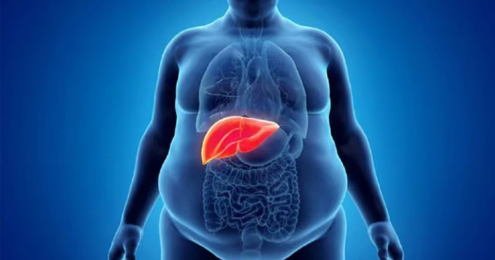 ফ্যাটি লিভার থেকে বাঁচতে যে ৩ পানীয় এড়িয়ে চলবেন