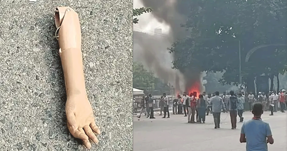 হাত ফেলে রেখে পালিয়ে গেলো জুলাইযোদ্ধা