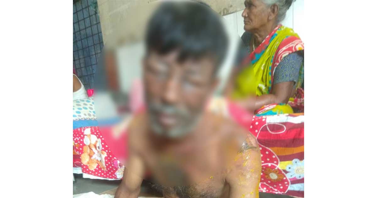 গরম পানিতে স্বামীর মুখ ঝলসে দিলো স্ত্রী