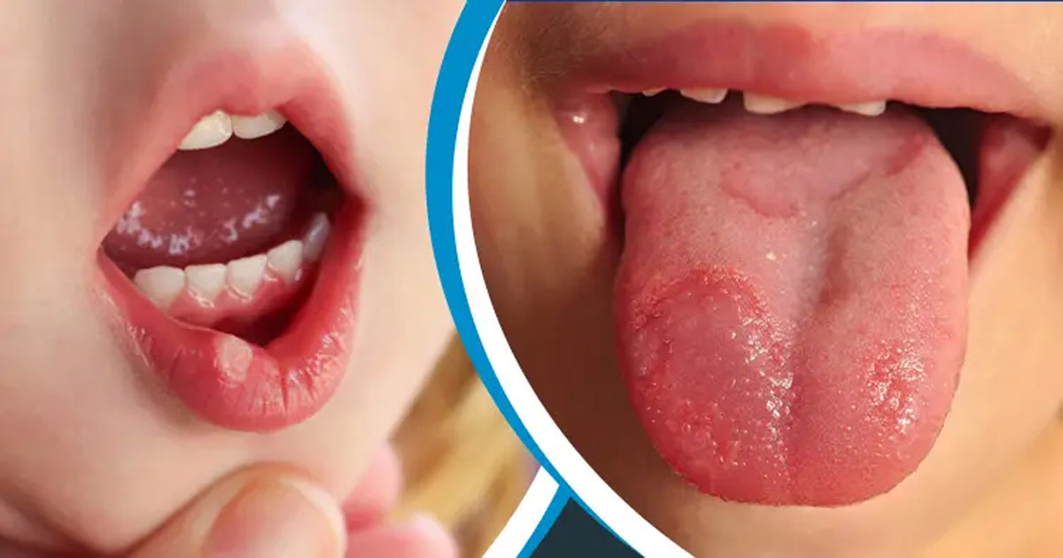 জিহ্বায় ঘা হলে করণীয়
