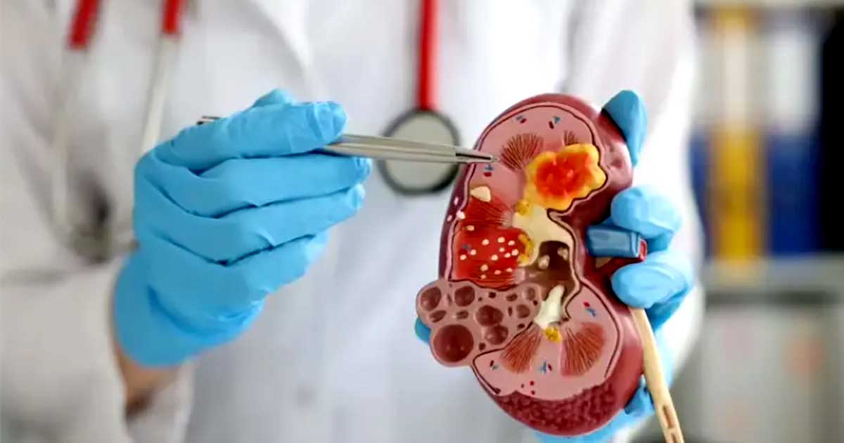 কিডনির ক্ষতি ডেকে  আনছে যে ৫ খাবার