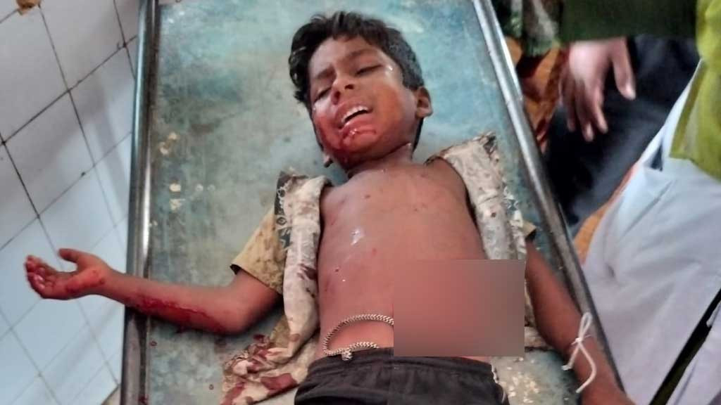 কুড়িয়ে পাওয়া’ বোমা বিস্ফোরণে ৩ ভাই-বোন আহত
