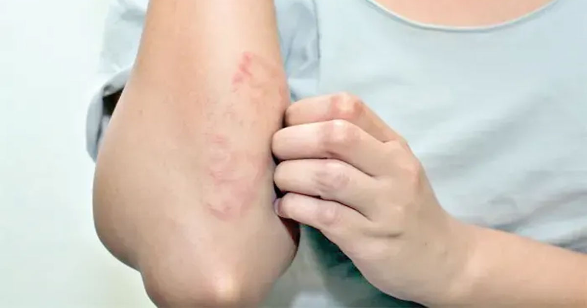 শীতে কেন ত্বক চুলকানি ও রুক্ষতা বাড়ে, কারণ ও করণীয় জানালেন চিকিৎসক