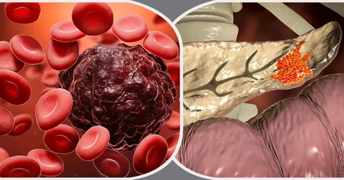 কোন রক্তের গ্রুপের মানুষের ক্যানসারের ঝুঁকি বেশি হয়