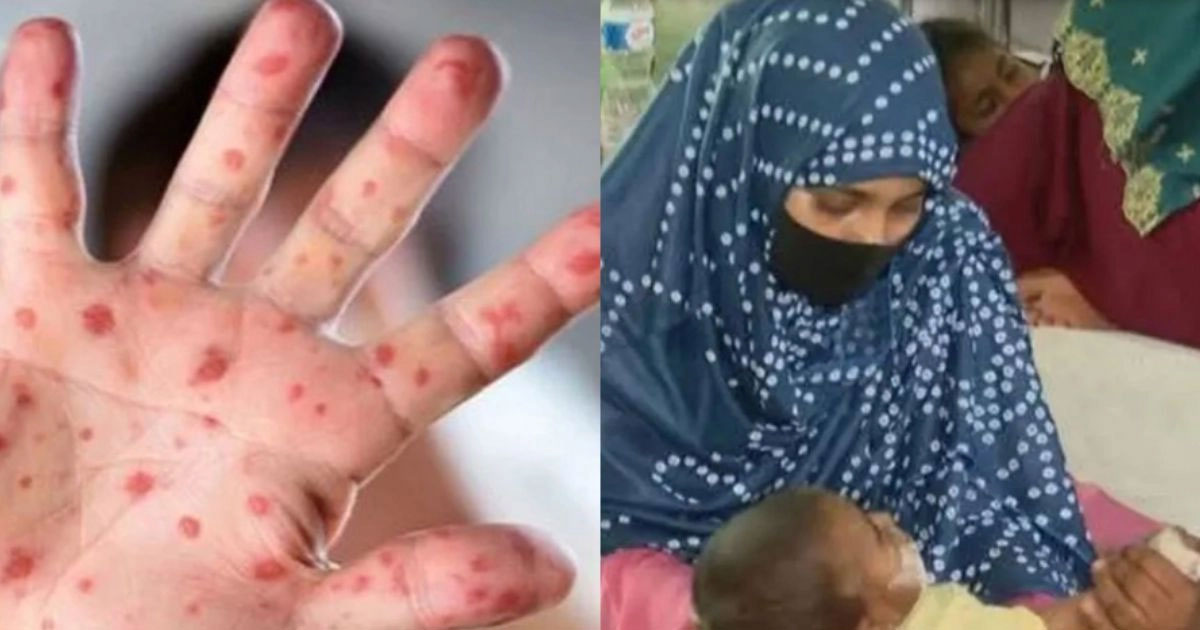 চার জেলায় হামের উপসর্গ নিয়ে ৪ শিশুর মৃত্যু