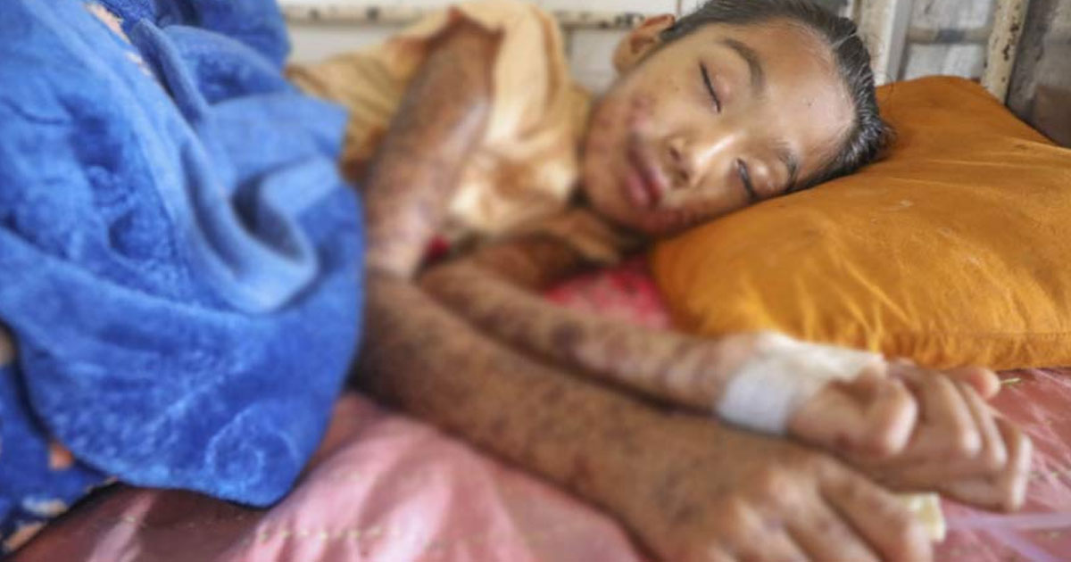 হামে ১৯ দিনে ৯৪ মৃত্যু