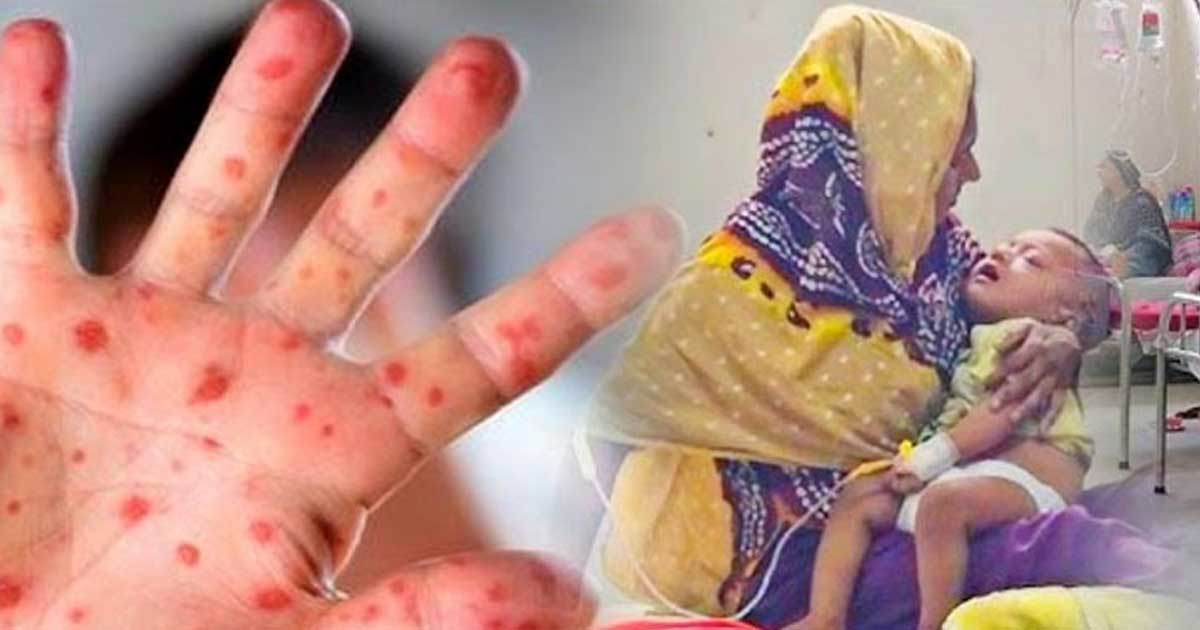 ২৪ ঘণ্টায় হামে সাত জনের মৃত্যু