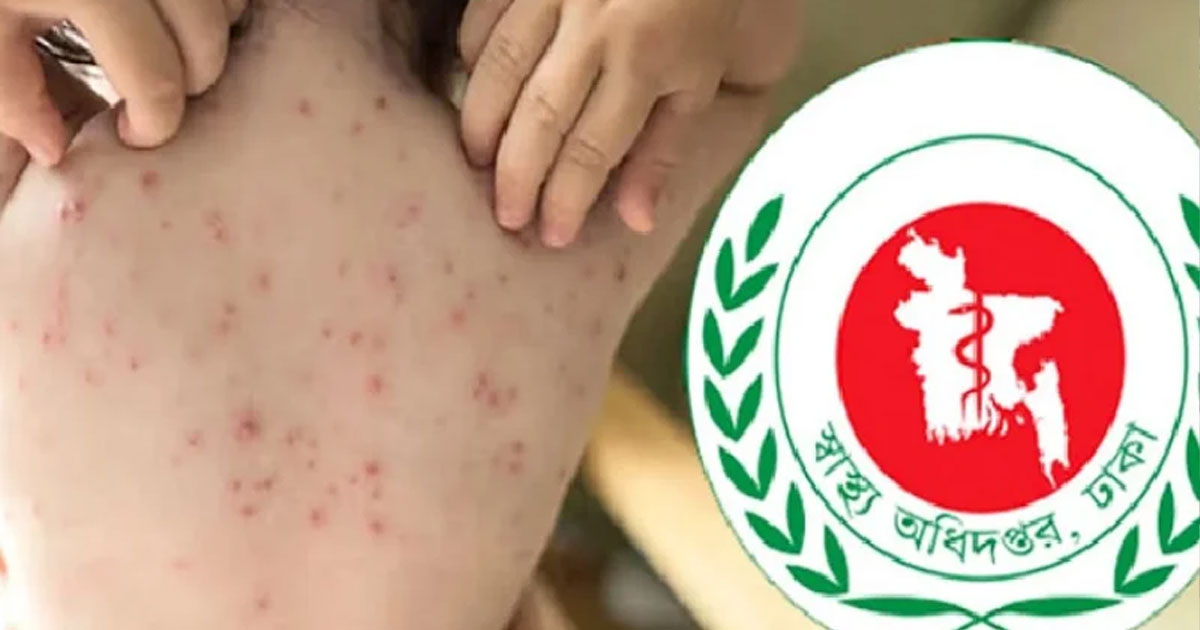 গত ২৪ ঘন্টায় হাম ও হামের উপসর্গে আরও ৫ শিশুর মৃত্যু