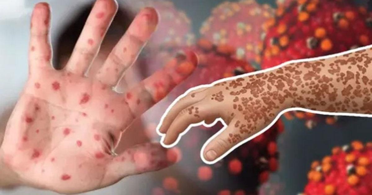 হাম ও হামের উপসর্গে আরও ৭ জনের মৃত্যু