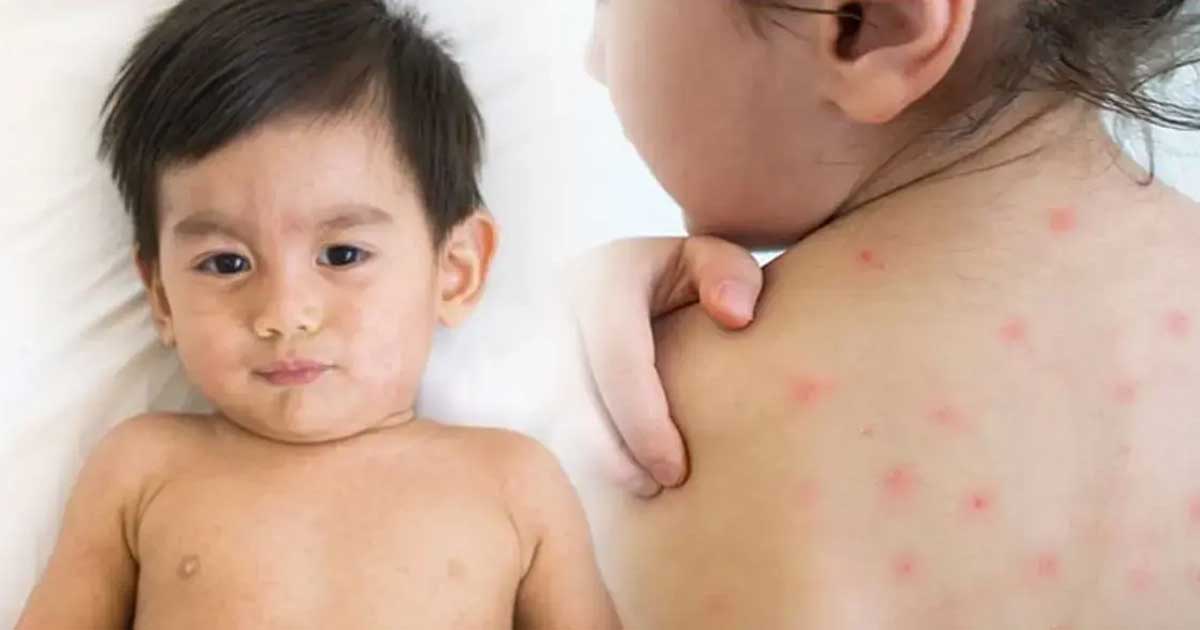 হাম ও উপসর্গে আরও পাঁচ মৃত্যু