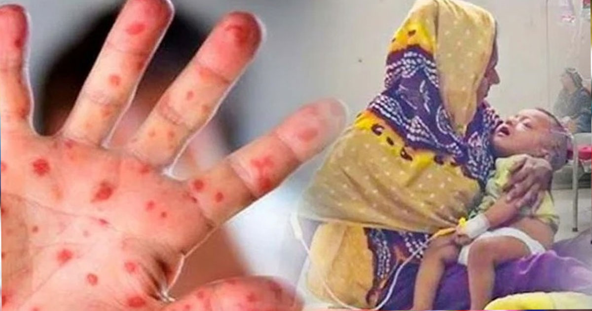 হাম ও হামের উপসর্গ নিয়ে  আরও ৯ শিশুর মৃত্যু