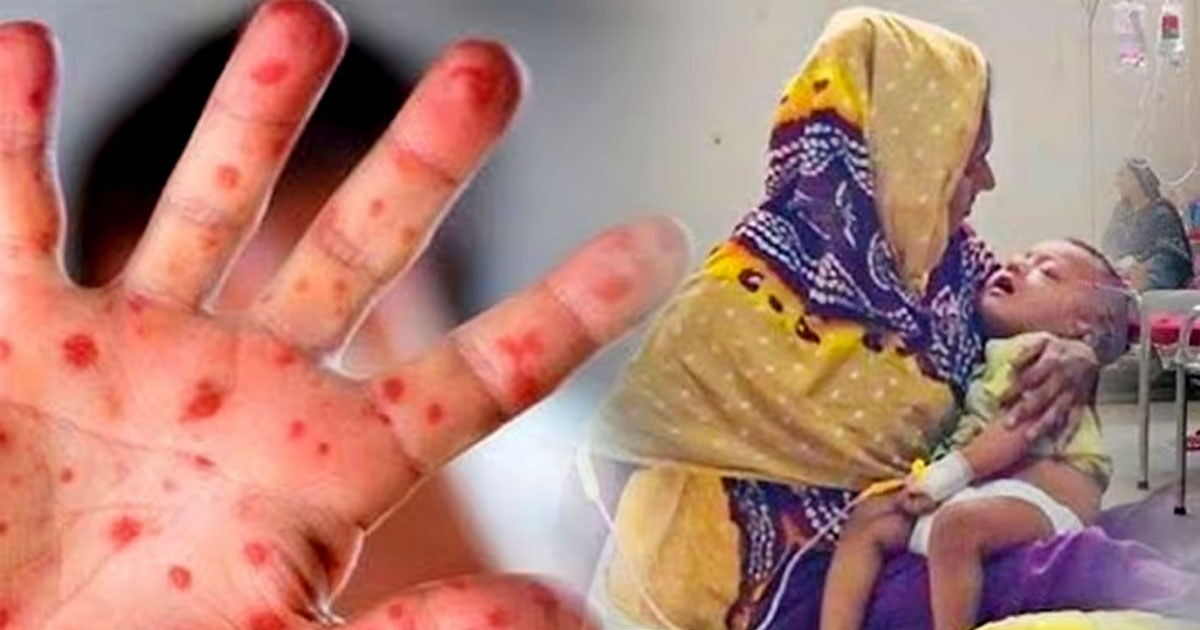 হাম ও হামের উপসর্গে আরও ১৭ শিশুর মৃত্যু, মোট মৃত্যু ৫৪৫