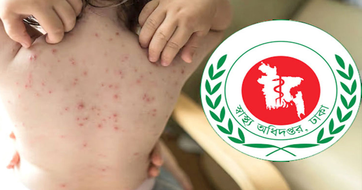 হাম উপসর্গে আরও ৭ জনের মৃত্যু