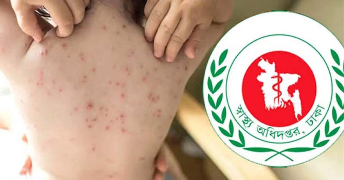 হাম ও উপসর্গে আরও ৪ শিশুর মৃত্যু