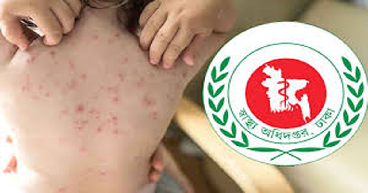 হাম উপসর্গে একদিনে আরও ৩ মৃত্যু