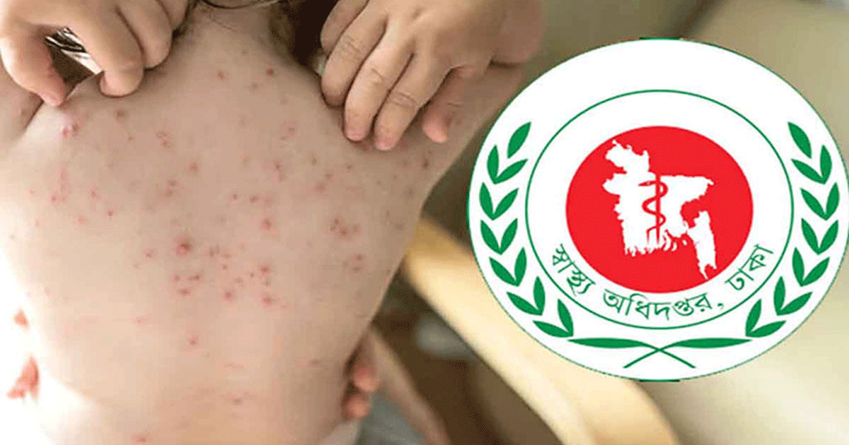 হামের উপসর্গে একদিনে আরও ৩ জনের মৃত্যু