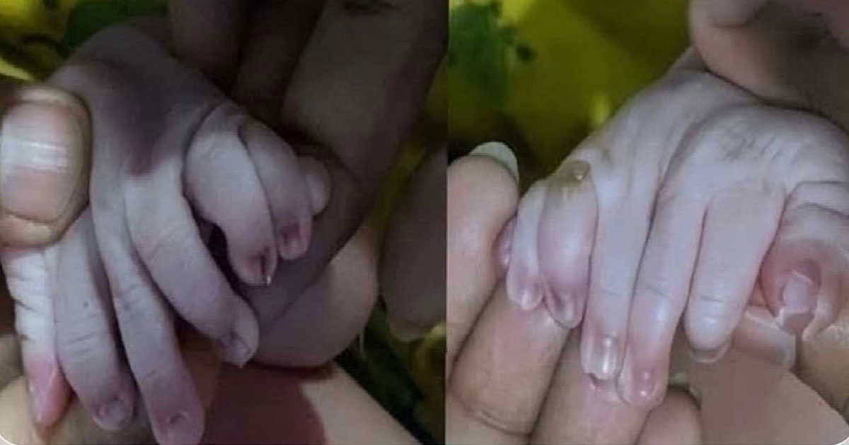 ৩০ আঙুল নিয়ে জন্মানো সেই নবজাতকের মৃত্যু