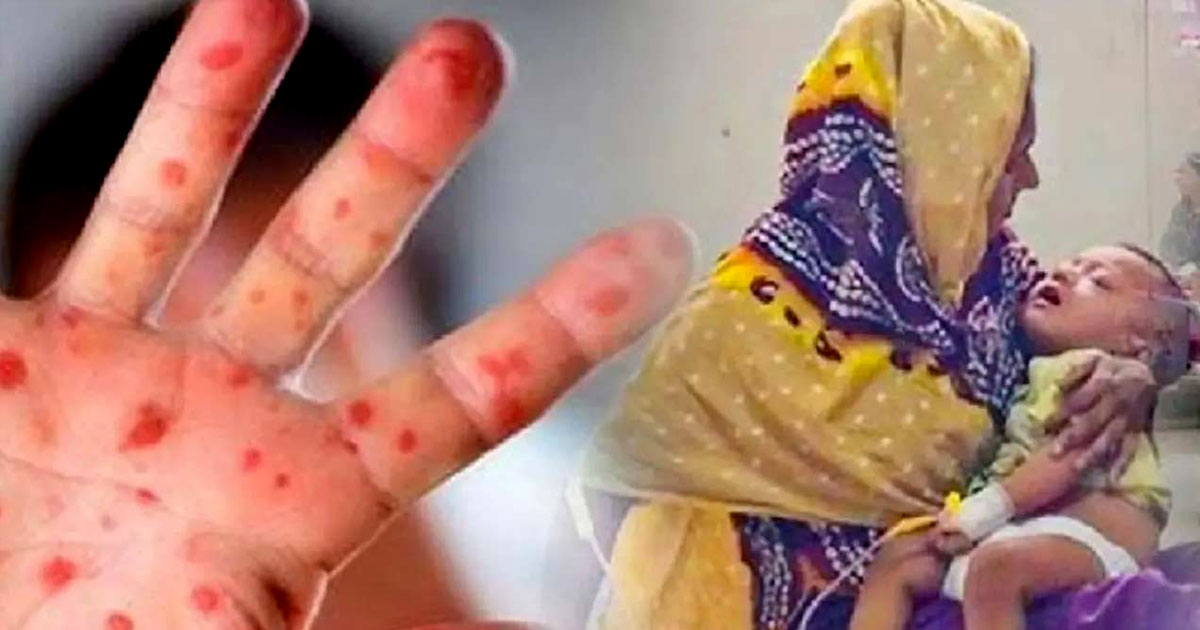 হামের উপসর্গে আরও এক শিশুর মৃত্যু, মোট মৃত্যু ৬৫৭