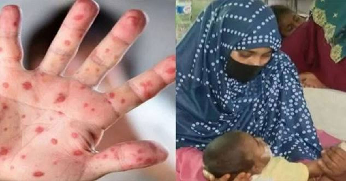 ২৪ ঘণ্টায় হাম উপসর্গে ৪ শিশুর মৃত্যু