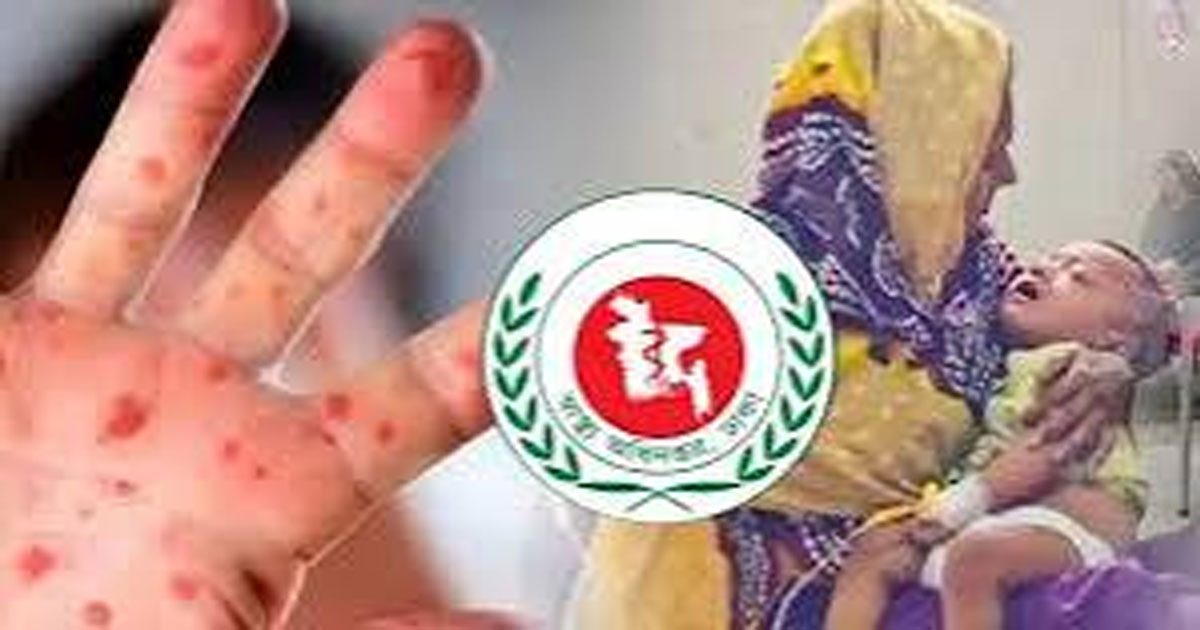 হাম উপসর্গে একদিনে আরও ৫ শিশুর মৃত্যু