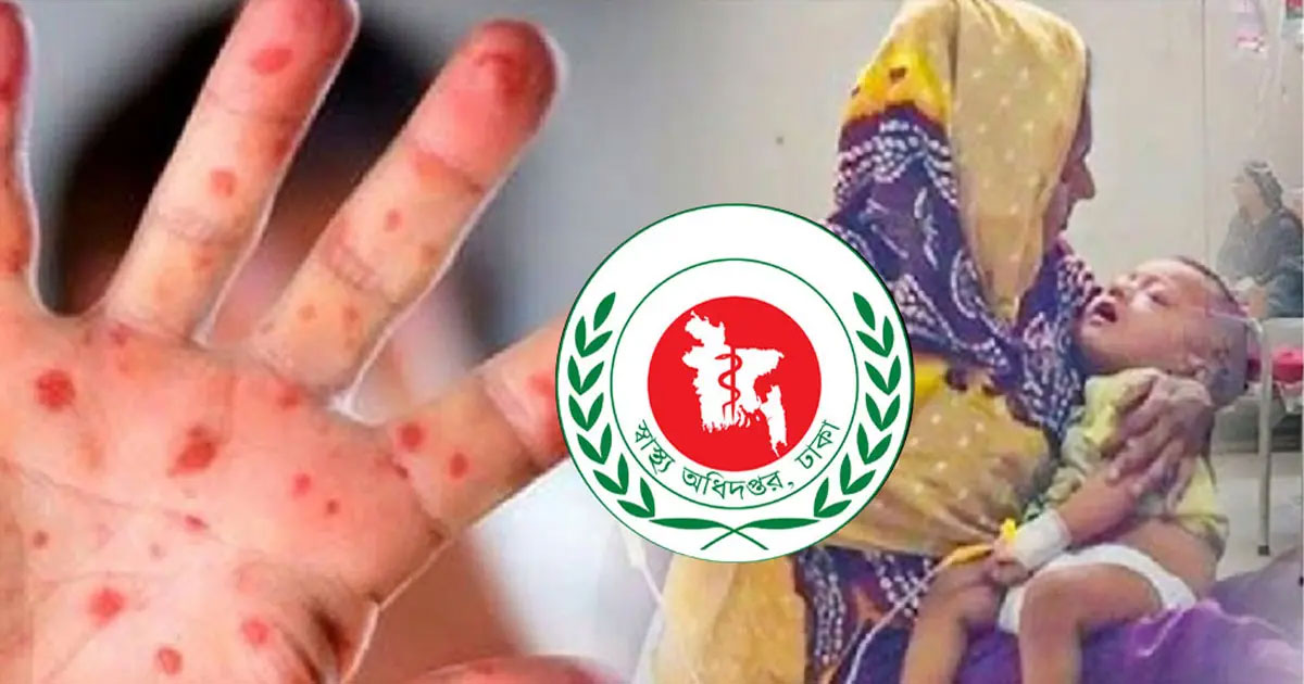 হামের উপসর্গে একদিনে আরও ৫ জনের মৃত্যু