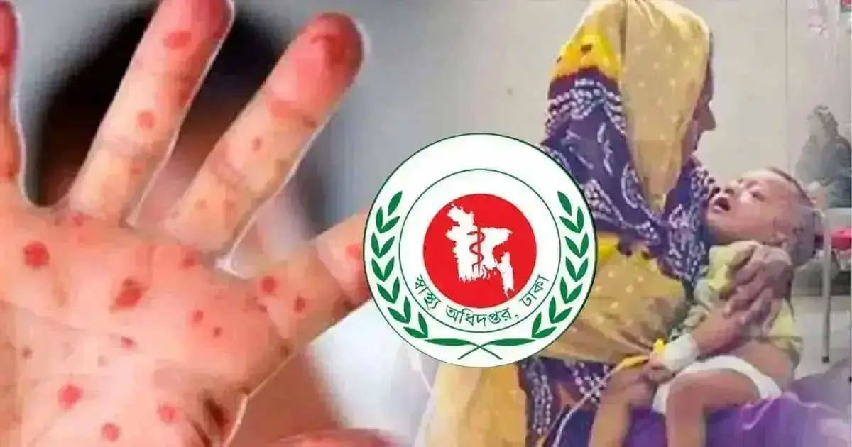 হাম উপসর্গে আরও ৩ জনের মৃত্যু
