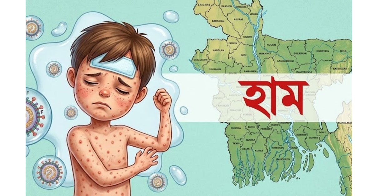 ২৪ ঘণ্টায় হাম সন্দেহে আরও ৪ জনের মৃত্যু