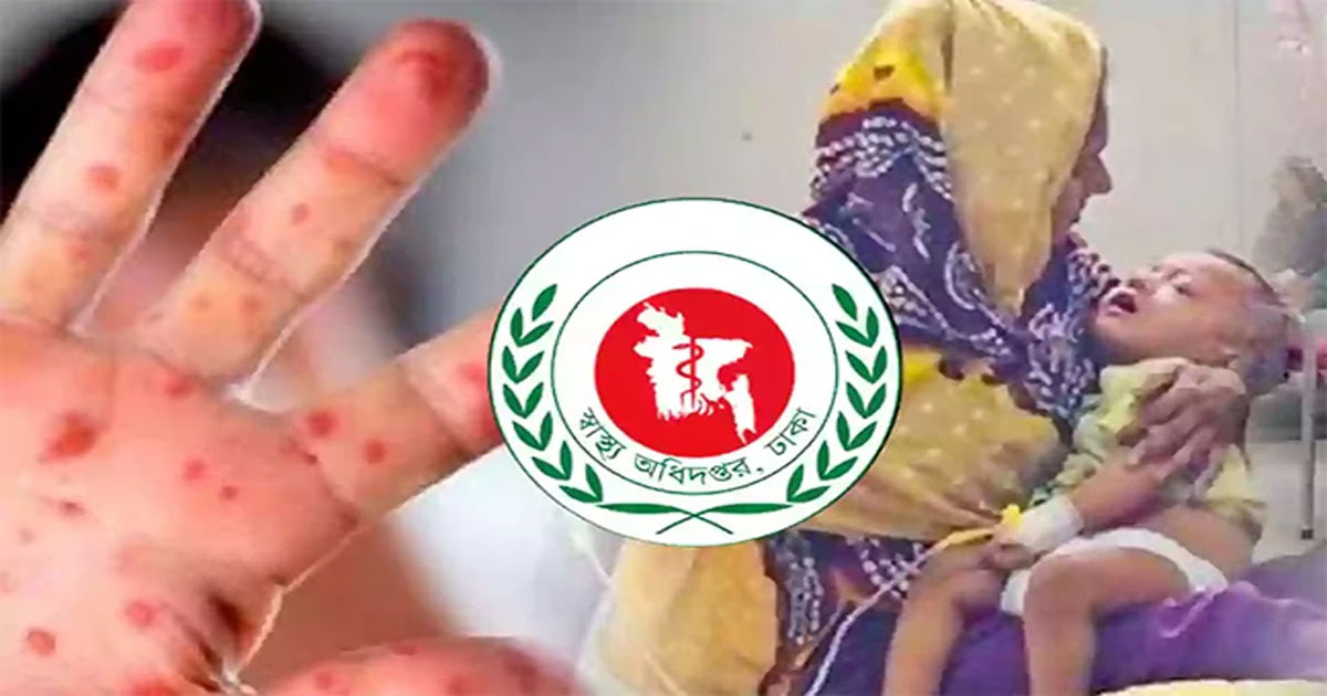হাম উপসর্গে আরও ২ শিশুর মৃত্যু