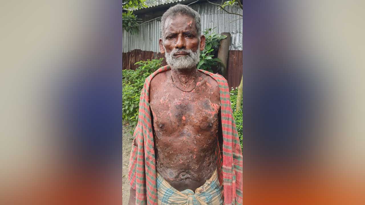 বাঁচতে চায় জয়পুরহাটে অসহায় আদিবাসী দিনমজুর মংলা