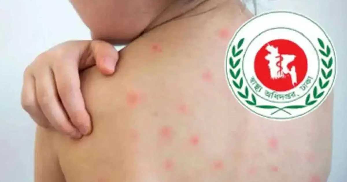 হাম উপসর্গে আরও ৬ শিশুর মৃত্যু