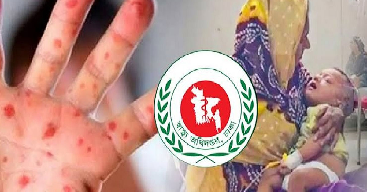 হামের উপসর্গে আরও ৬ জনের মৃত্যু