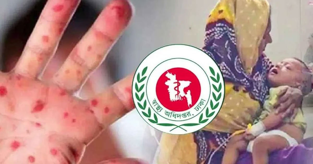 হাম উপসর্গে আরও ৩ শিশুর মৃত্যু