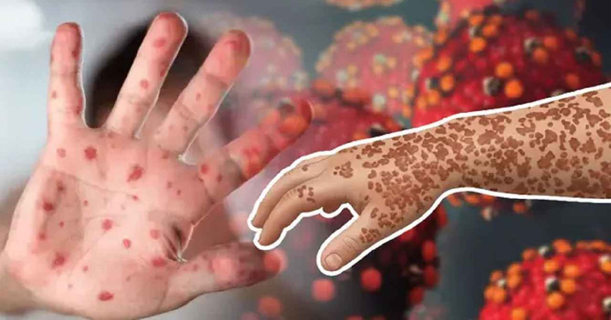 হাম ও উপসর্গ নিয়ে দেশে আরও ১০ শিশুর মৃত্যু