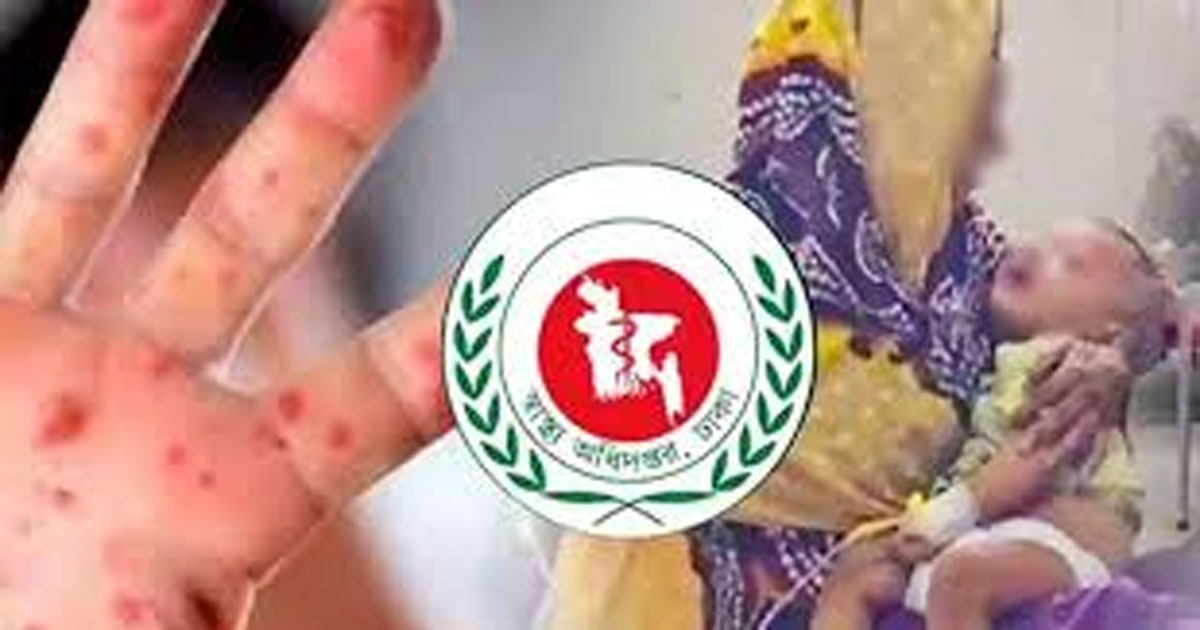 ২৪ ঘণ্টায় হাম ও উপসর্গে আরও ৮ শিশুর মৃত্যু