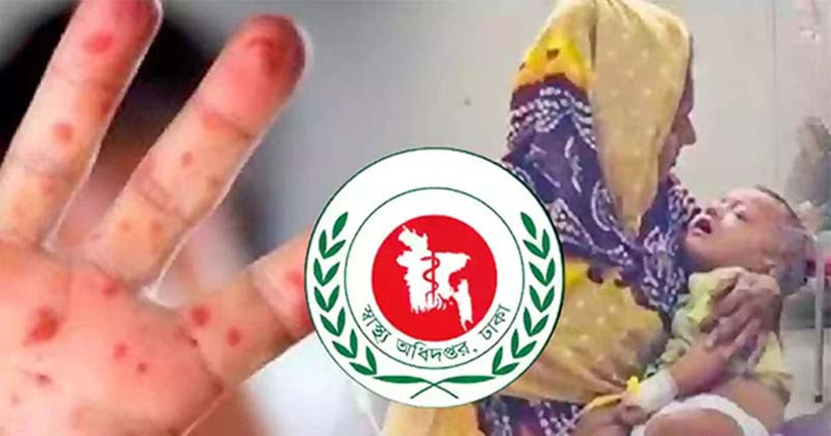 হাম ও হামের উপসর্গে আরও ৯ জনের মৃত্যু