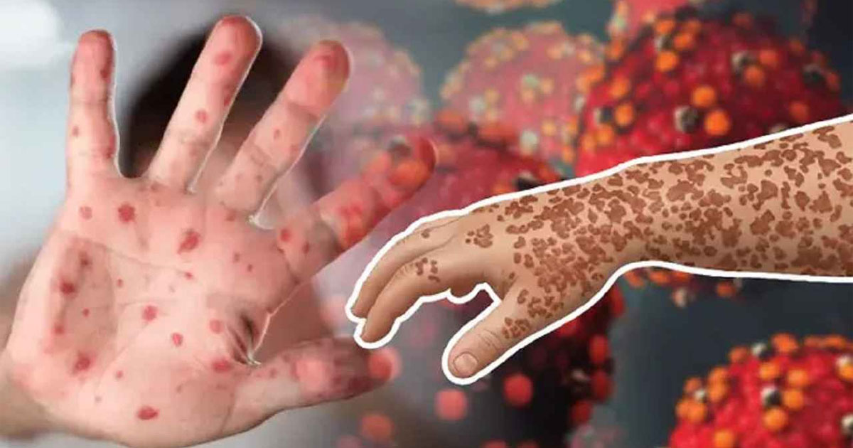 হাম ও উপসর্গে মৃত্যু ৫০০ ছাড়াল