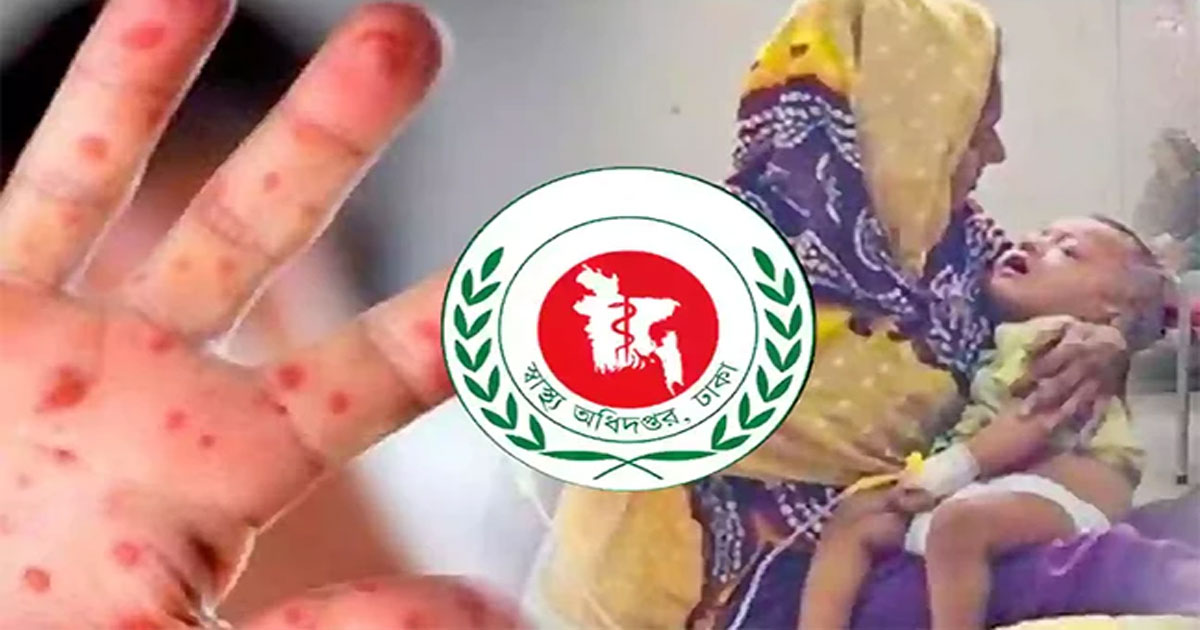 হাম উপসর্গে প্রাণ গেল আরও ২ শিশুর, মোট মৃত্যু ৫৮৫