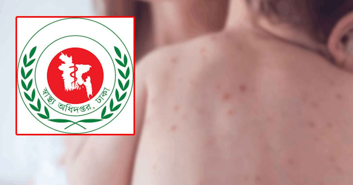 হাম উপসর্গে আরও ৭ শিশুর মৃত্যু মোট মৃত্যু ৬২০